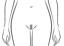 Maybe you would like to learn more about one of these? Epilation Laser Definitive Maillot Prix Photos Avant Apres Douleur Danger