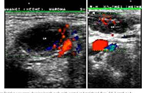 Nearly all skin cancers can be treated effectively if they are found early, so knowing what to look for is important. Utility Of Color Doppler Ultrasound In Evaluating The Status Of Cervical Lymph Nodes In Oral Cancer Semantic Scholar