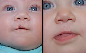 As your child recovers, they will require less and less pain medicine. Primary Cleft Lip Nasal Reconstruction Gallery St Louis Childrens Hospital