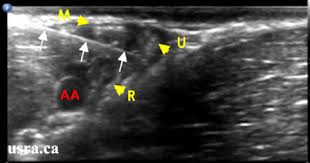 Image result for Axillary Nerve Block