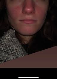 Do hands get red and swollen when drinking?