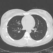 It can be classified as either pulmonary, or pleural, respectively. Catamenial Pneumothorax Radiology Case Radiopaedia Org