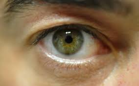 Slik blir du kvitt hodepinen. Endoftalmitt Nhi No