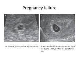 On sixth week pregnancy, most women have definite physical changes in the body. Abnormal Ultrasound In Early Pregnancy