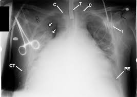 Image result for XRay Changes in Rheumatic Conditions