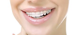 How to clean plastic retainers for teeth. 8 Tips To Keep Your Retainer Safe And Clean