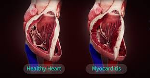 Image result for Myocarditis