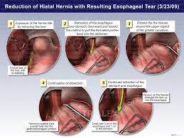 Image result for Hernia Reduction