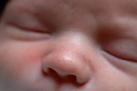 Check spelling or type a new query. Rashes In Babies And Children Nhs
