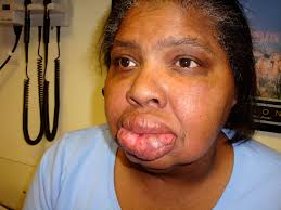 A Rare Case of Orofacial Granulomatosis