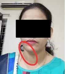 Discover more posts about weight gain, glorifying obesity, obese, fat, immobility, extreme weight gain, and immobile. Soft And Immobile Mass In The Left Anterior Side Of Her Neck Beneath Download Scientific Diagram