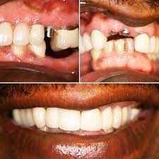 No Teeth No Problem Before And After Of Multiple Implant Restorations Done By Dr Heyrani Patient Couldn T Be Any Happier C Dental Dentist Orthodontist