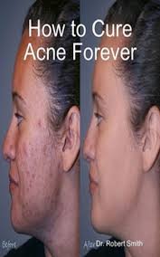How To Cure Acne Forever Ebook By Dr Robert Smith Rakuten Kobo