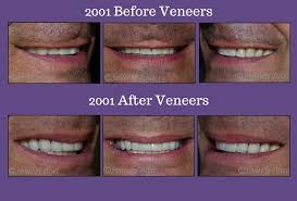 7 reasons to get cosmetic dentistry. Charlotte Cosmetic Dentist Replacing Porcelain Veneers After 15 Years