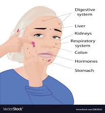 Acne Diagram Face Technical Diagrams