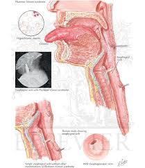Dysphagia is the first and most prominent symptom. Plummer Vinson Syndrome
