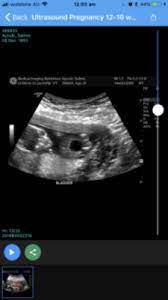 Baby Has Enlarged Bladder March 2019 Birth Club Babycenter Australia