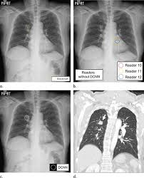 Image result for Chest XRay