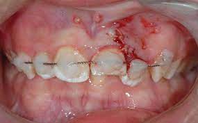 Child S Permanent Tooth Knocked Out Of Its Socket Here S What To Do Healthxchange