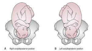 Image result for Manual Rotation in Occipitoposterior Presentation