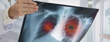 The s sign of golden is seen when a collapsed upper lobe. Lung Cancer Screening Johns Hopkins Medicine