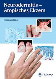 The skin microbiome consists of bacteria, viruses and fungi. Neurodermitis Atopisches Ekzem Ebook Ring Johannes Amazon De Kindle Shop