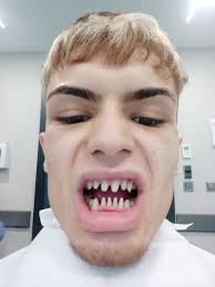 Model says he looks like a 'shark' after £3,000 Turkey teeth surgery