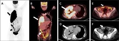 mesothelioma has a long latency period of 20 to 40 years, and many patients do not have symptoms until the disease is in its later stages, when metastasis is more likely to occur. Pleuroperitoneal Mesothelioma A Rare Entity On 18f Fdg Pet Ct Abstract Europe Pmc