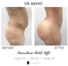 Surgery journey in miami with mia aesthetics. Mia Aesthetics Before And After By Dr Mehio Miami Miaaesthetics Miababe Miagoals Bbl Snatched Plasticsurgery Facebook