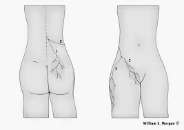 See also the more common superior cluneal nerve entrapment, as well as middle cluneal nerve entrapment. Lumbo Pelvic Pain Part One