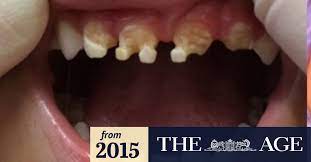 However, by working with your dentist, you can safely fix your teeth. Kids As Young As 18 Months Needing Rotten Teeth Pulled Because Of Bad Decay