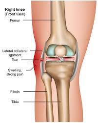 Tears of the meniscus, the cushion between the bones, can occur as the result of an injury, or as a result of wear and tear. Lateral Collateral Ligament Injury Symptoms Treatment Rxharun