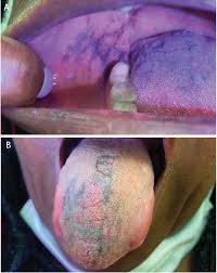 Image result for lichen planus on tongue)