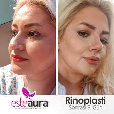 dogal burun estetigi rinoplasti bursa auralar