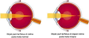 Agar bayangan jatuh di retina sinar yang masuk pada lensa mata, titik dekat harus lebih mengumpul. Sebutkan 3 Tiga Jenis Cacat Mata Dan Penyebabnya