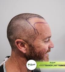 Mono Hair Transplant