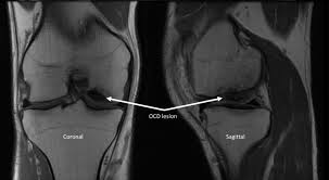 The changes were frequently bilateral, but were not. Osteochondral Allograft Transplantation Of The Medial Femoral Condyle With Orthobiologic Augmentation And Graft Recipient Microfracture Preparation Arthroscopy Techniques
