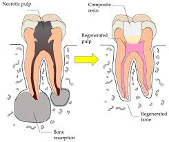 Image result for Pulpitis