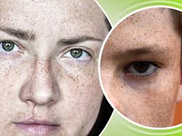 If you don't know how to eliminate freckles fast, this problem has a negative impact. How To Get Rid Of The Freckles At Home Naturally Lifealth