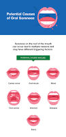 Image result for oral thrush symptoms roof of the mouth