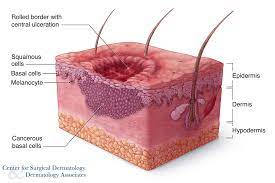 Identifying The Types Of Basal Cell Carcinoma - Center For Surgical  Dermatology