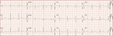 Las máquinas de electrocardiograma son un equipo estándar en los quirófanos y las ambulancias. Como Interpretar Un Electrocardiograma El Blog De Girodmedical Magento Title