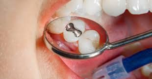 If your fillings need more time to set fully, you may need to avoid hard and sticky foods for a while. White Fillings Damira Dental