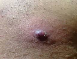 Ingrown hair removal on labia! How To Get Rid Of Ingrown Hair On Vagina