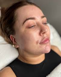 Skin staples: Dermaplaning 🪞 Dermaplaning exfoliates the skin which in  turn removes dead skin cells, vellus hair, excess build up