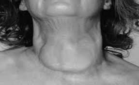 Image result for Goiter