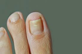 Nagelkrankheiten In Bildern Bruchige Fingernagel Weisse Nagel Co Gesundheit De