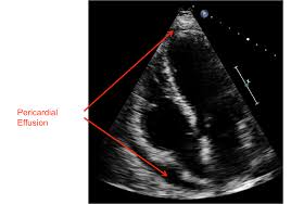 Image result for Pericarditis