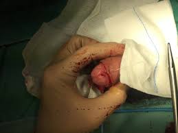 Fimosi e circoncisione del pene: sintomi, rischi e cura