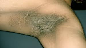 Doctors say most of their patients arrive late, when they are already losing vision, and doctors have to surgically remove the eye to stop the infection from reaching the brain. 10 Diabetic Skin Problems Everyday Health